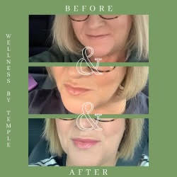 Wellness by Temple Dermal Filler